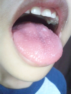 舌 いちご