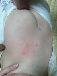 水疱瘡 2012/04/24 13:50:00