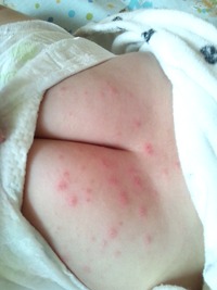 手足口病？？？ 2011/09/04 21:59:12