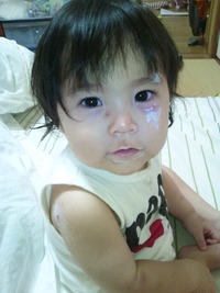 水疱瘡～経過 2012/04/25 19:39:24