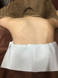 背中があっという間に綺麗に♡びっくり♡花嫁さん 2018/06/22 09:28:34