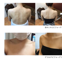 背中のニキビが気になりドレスが着れない！！諦めないで！！ 2017/12/13 11:49:54