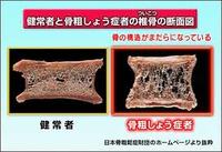 骨粗しょう症　カルシウムだけでは不十分　ヾ(oﾟｘﾟo)ﾉ